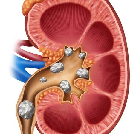 ಮೂತ್ರದ ಕಲ್ಲು (Kidney Stone) ಪುತ್ತೂರು ಭಟ್ಟರ ಔಷಧಿ ರಾಮಬಾಣ…..
