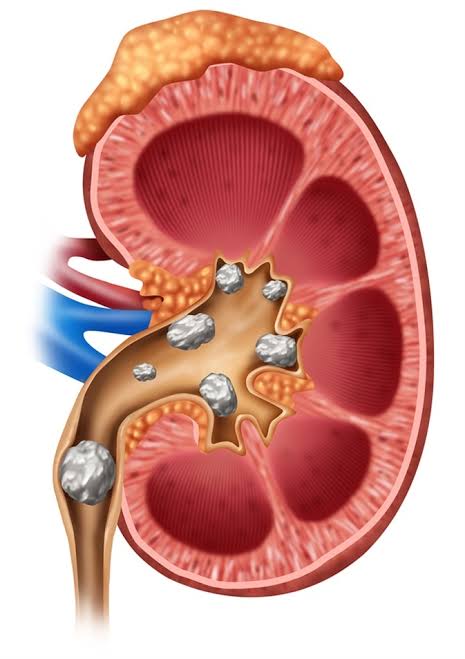 ಮೂತ್ರದ ಕಲ್ಲು (Kidney Stone) ಪುತ್ತೂರು ಭಟ್ಟರ ಔಷಧಿ ರಾಮಬಾಣ…..